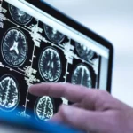 How Does Alcohol Affect and Damage your Brain