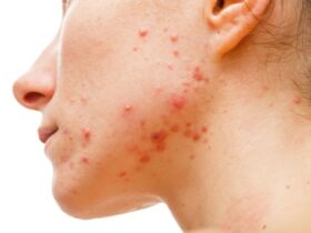 Monkeypox Symptoms Usually Appear Like This, According to an Infectious Disease Expert