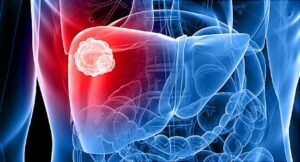 Read more about the article Sure Signs Your Liver Isn’t As Strong as it Should Be