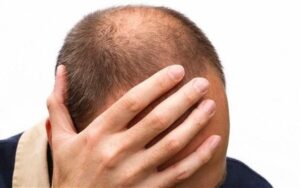Read more about the article Does Hair Gel Cause Hair Loss?