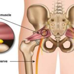 Sciatic Nerve Pain: Causes, Symptoms and Treatment