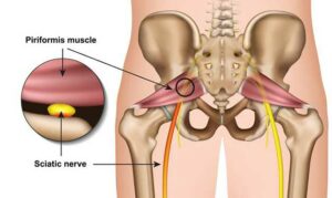 Read more about the article Sciatic Nerve Pain: Causes, Symptoms and Treatment
