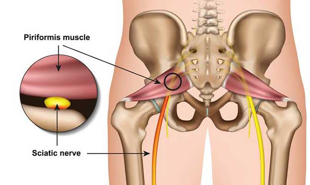 Sciatic Nerve Pain