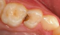 Read more about the article kill tooth pain nerve in 3 seconds permanently
