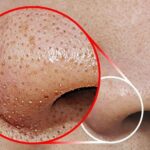 How Blackhead Extraction Works: A Guide to Clearing Your Pores