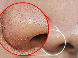 Read more about the article How Blackhead Extraction Works: A Guide to Clearing Your Pores